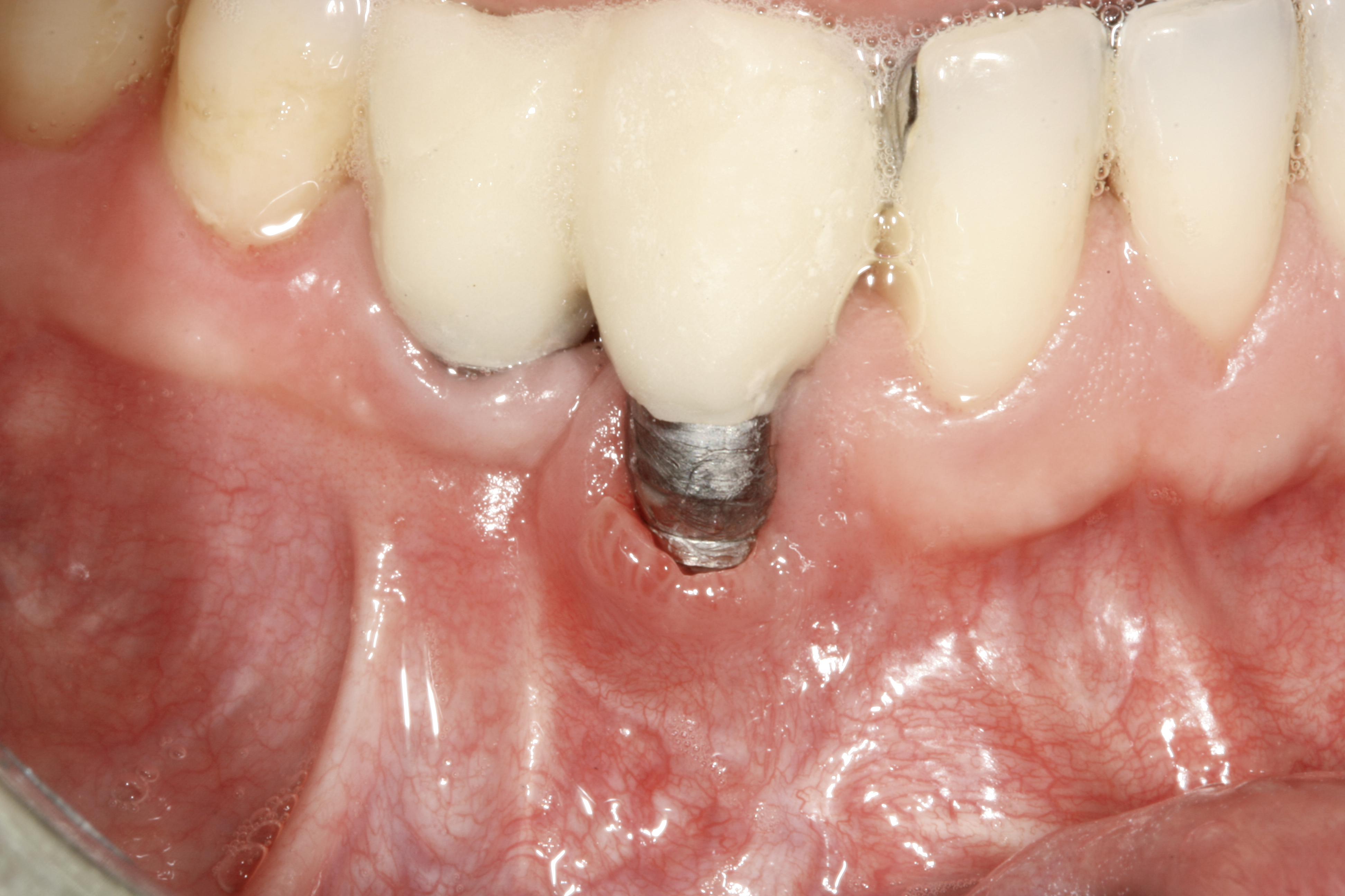 Peri_implantitis