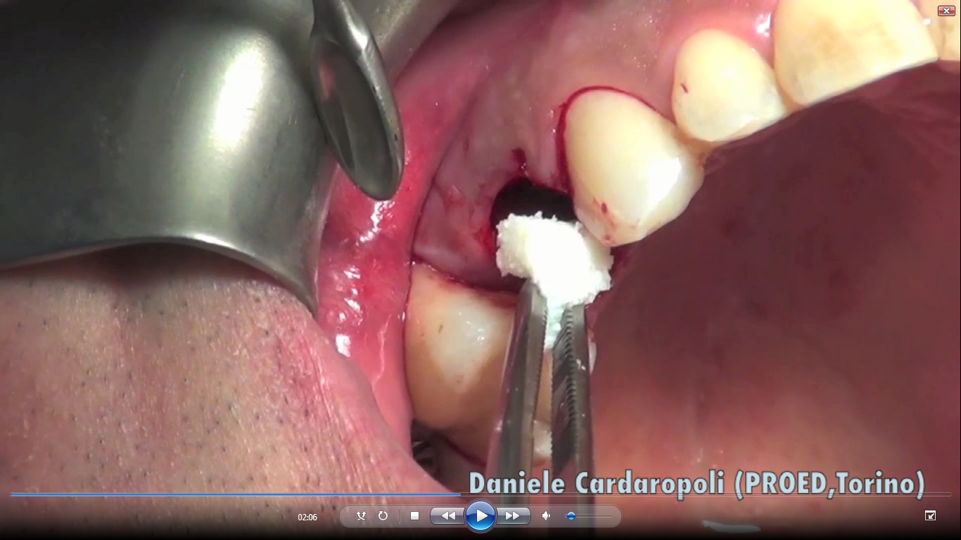 Surgery_movies_socket_preservation_cardaopoli