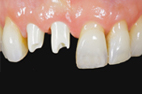 Single-tooth-abutment