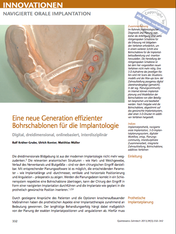 Eine-neue-generation-effizienter-bohrschablonen-fuer-die-implantologie