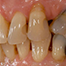 Implant uncoverage in functional areas - basic considerations