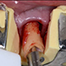 Systematic approach of treating a case with dental implants