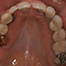 Definitions and characteristics of the different implant time-points after tooth extraction
