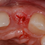 Basic principles of ridge alteration after tooth extraction