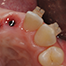 Therapeutic options after tooth extraction