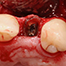 Implants in the partially edentulous anterior region
