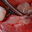 Pre-operative soft tissue management