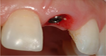 Immediate implant placement -factors influencing the esthetic success