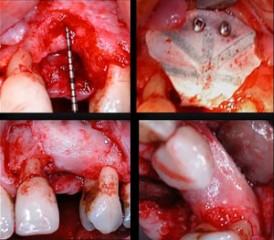 Dental implants in systemically compromised patients