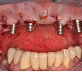 Immediately loaded implants with screw-retained hybrid restorations in edentulous patients- part II