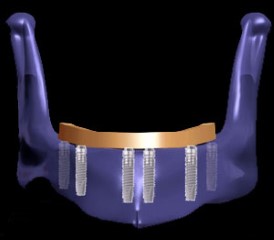 Immediately loaded implants with screw-retained hybrid restorations in edentulous patients - part I