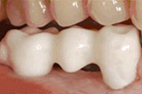 Multiple-teeth-bridge